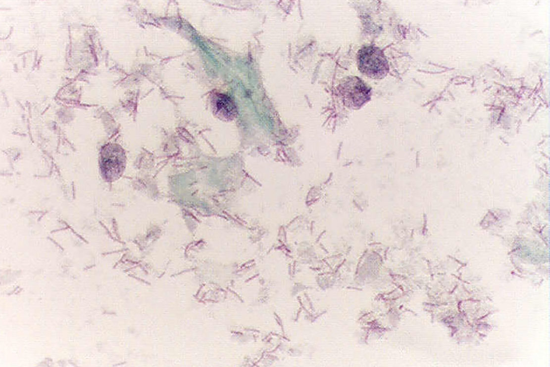 デーデルライン細菌 (細い桿菌) と細胞溶解性膣上皮細胞